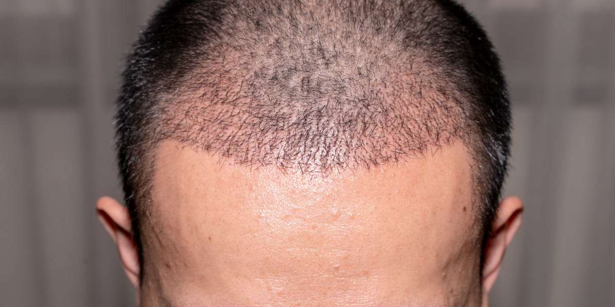 All About Hair Transplant Surgery