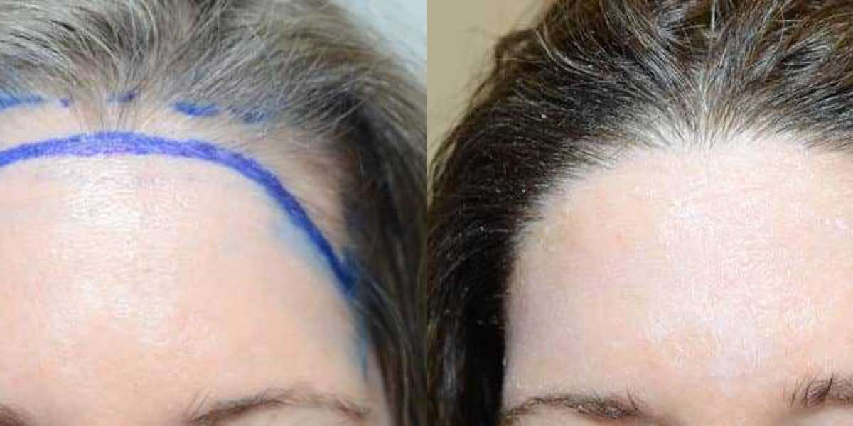 Hair Transplant To Lower Hairline