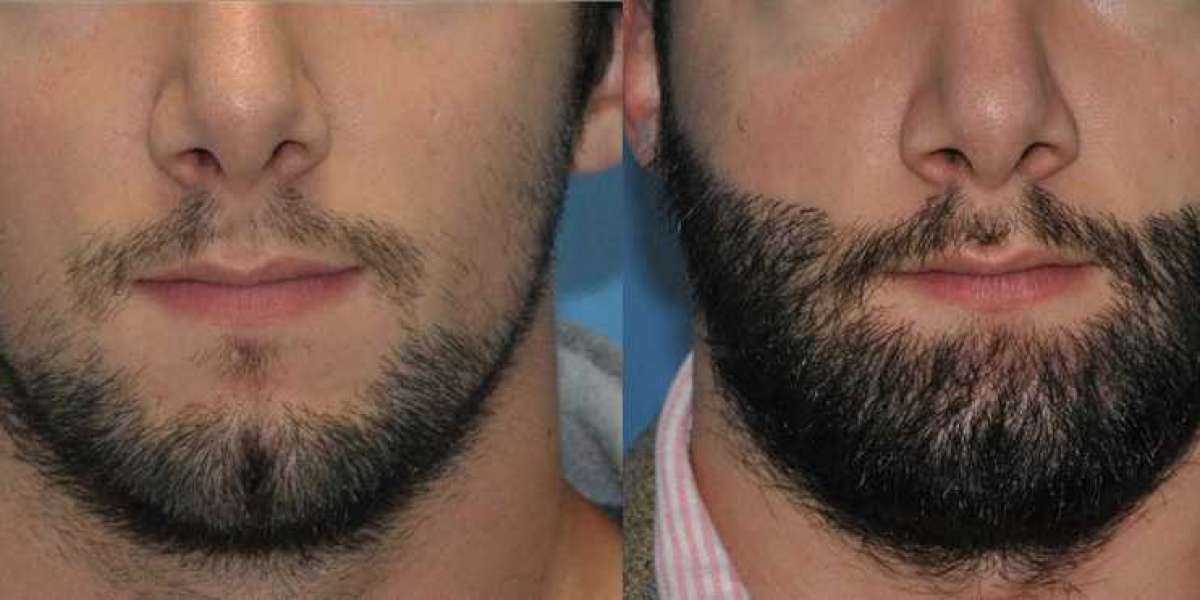 Facial Hair Implant