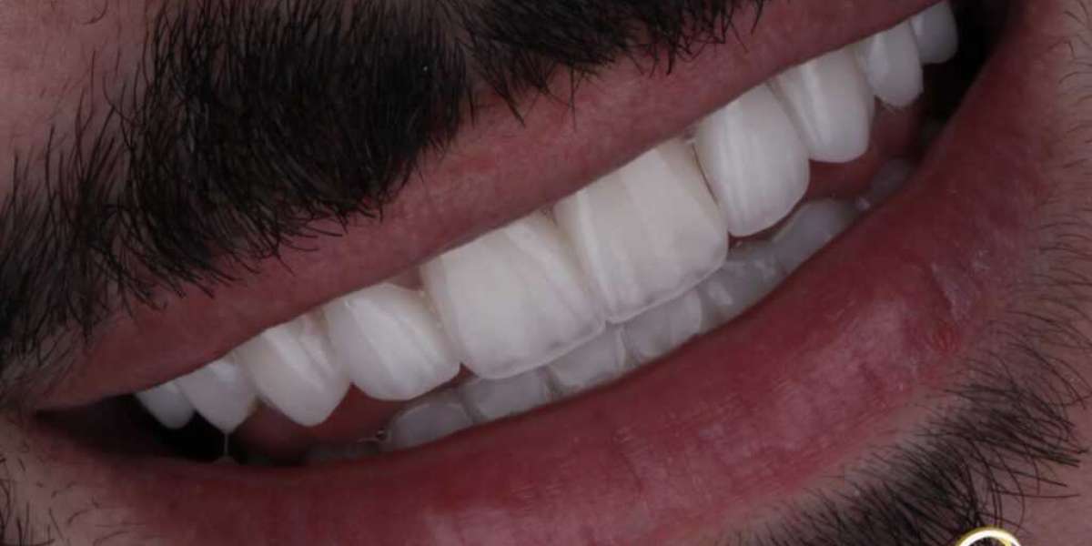 Transform Your Smile with a Hollywood Smile in Dubai: Radiate Confidence with Perfectly