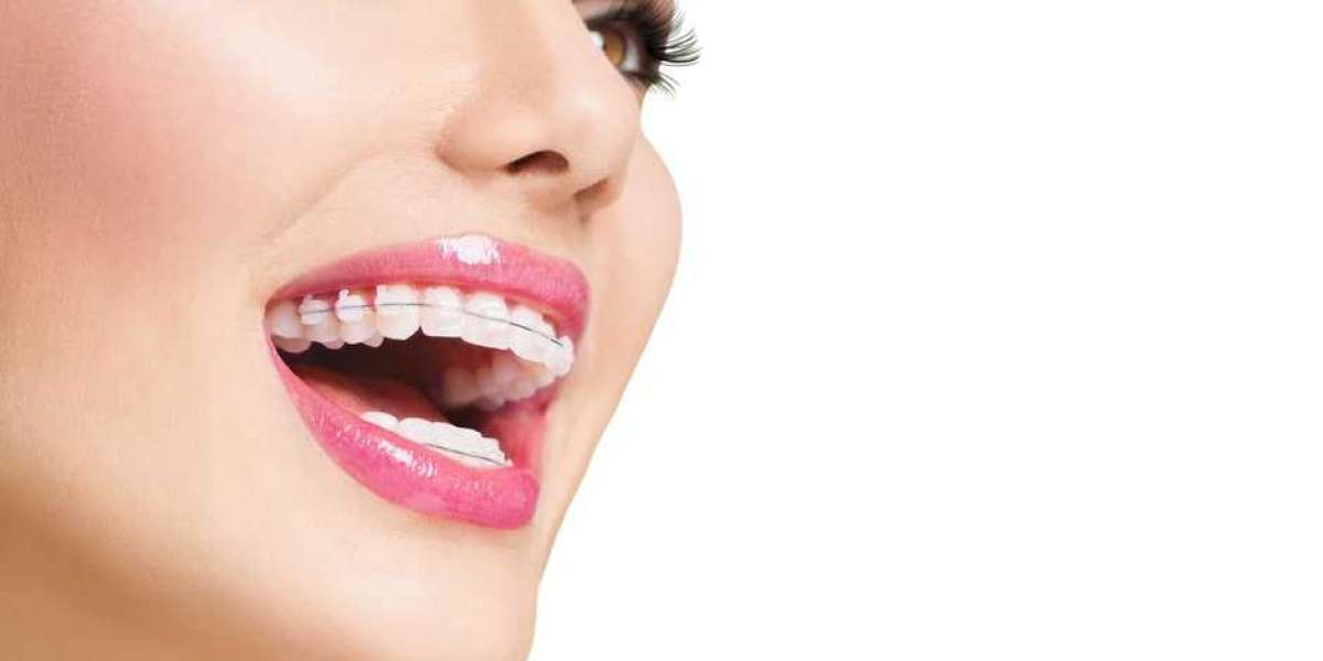 Achieve a Perfect Smile with Ceramic Braces in Dubai: Discreet and Effective Teeth Straightening
