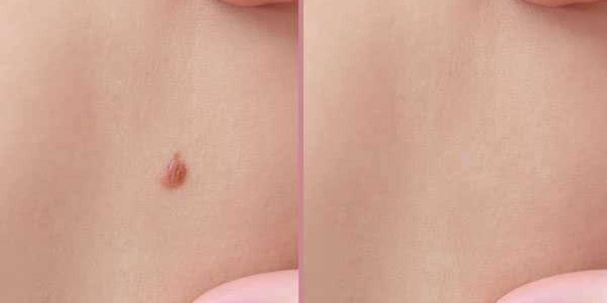 How Can you permanently remove moles?