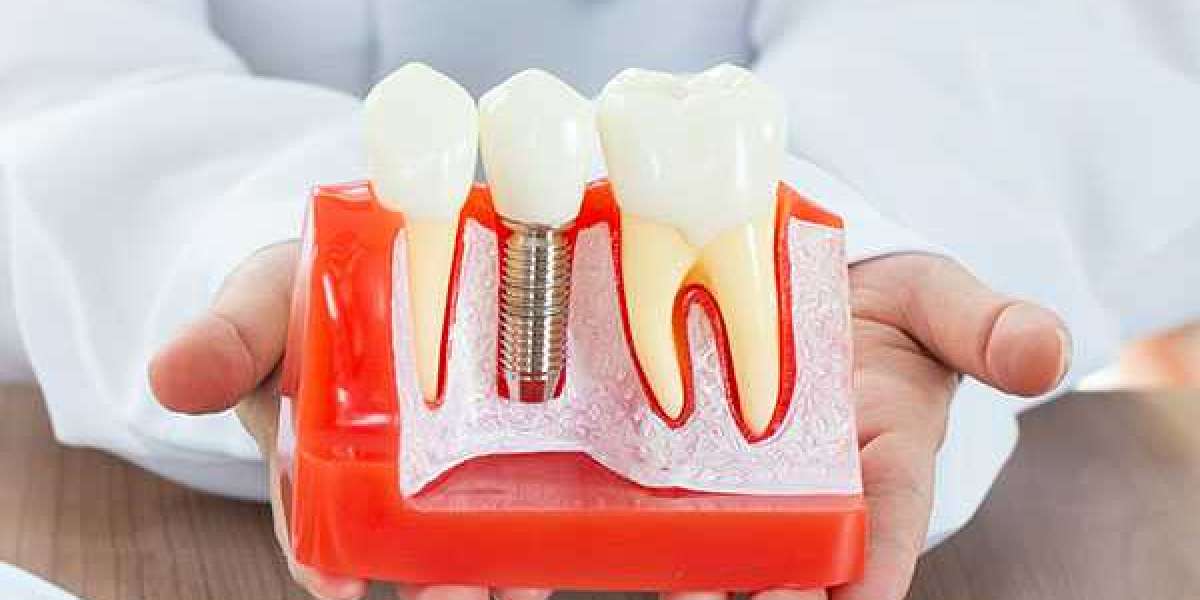 Which is the best place for dental implants?