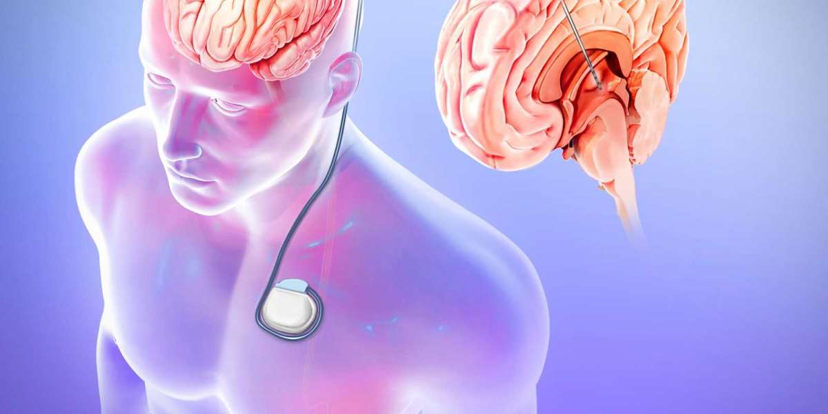 The Epilepsy Surgery Market Outlook Reveals Industry Growth Trends